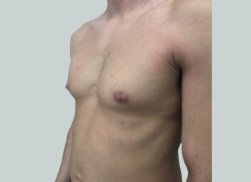 26911-coolsculpting-male-abdomen-chest-after