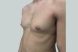 26911-coolsculpting-male-abdomen-chest-after