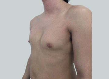 26911-coolsculpting-male-abdomen-chest-before