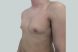 26911-coolsculpting-male-abdomen-chest-before