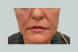 26928_nasolabial_folds_after