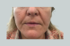 26928_nasolabial_folds_before