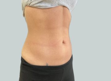 27376-coolsculpting-female-abdomen-after