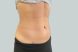 27376-coolsculpting-female-abdomen-after