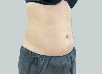 27376-coolsculpting-female-abdomen-before