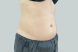 27376-coolsculpting-female-abdomen-before