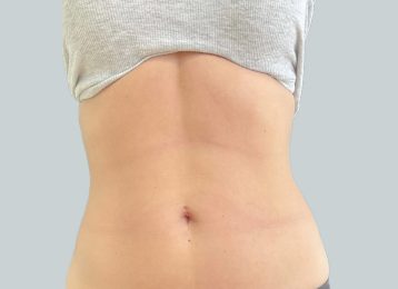 27376-coolsculpting-female-stomach-after