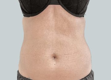 27376-coolsculpting-female-stomach-before