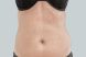 27376-coolsculpting-female-stomach-before