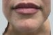 27429_lip_filler_after