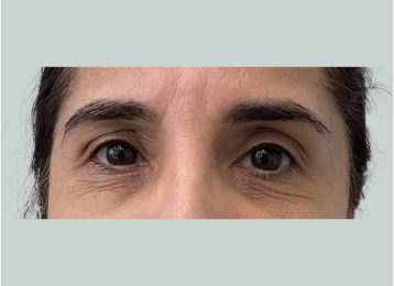 28495_microneedling_prp_face_female_before