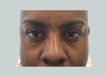 287929_undereyefiller_before