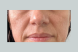 29696_nasolabial_folds_before