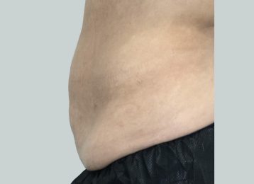 30098-coolsculpting-female-stomach-after