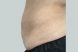 30098-coolsculpting-female-stomach-after