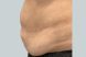 30098-coolsculpting-female-stomach-before