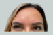 30160_female_dysport_forehead_after