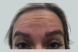 30160_female_dysport_forehead_before