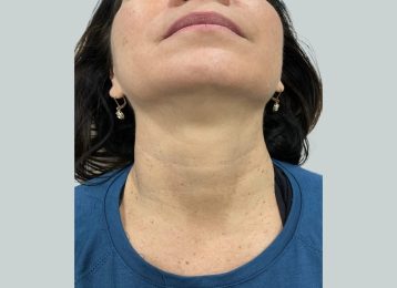 30237_sculptra_neck_female_before