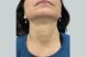 30237_sculptra_neck_female_before