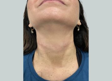 30237_sculptra_neck_females_after