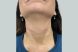 30237_sculptra_neck_females_after