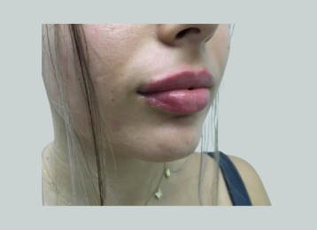 30768_lip_filler_after