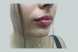 30768_lip_filler_after