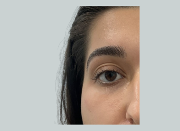 30779_undereye_filler_female_after