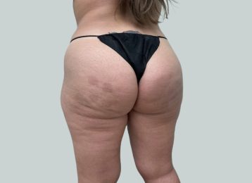 31271_sculptra_buttocks_female_before