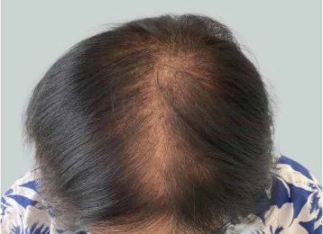 31279_microneedling_prp_hairloss_female_after-1