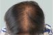 31279_microneedling_prp_hairloss_female_after-1