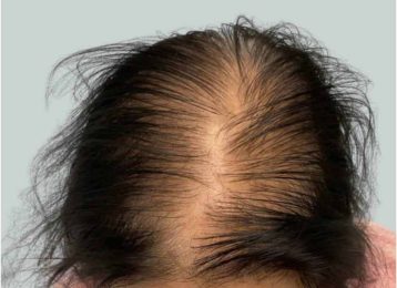 31279_microneedling_prp_hairloss_female_before