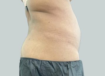 31407-medical-weight-loss-belly-after