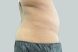 31407-medical-weight-loss-belly-after