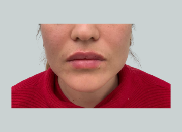 31481_lipfiller_before