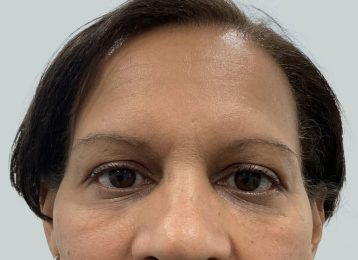 31643_undereye_filler_female_after