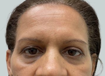 31643_undereye_filler_female_before