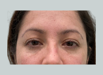 31658_undereye_filler_after