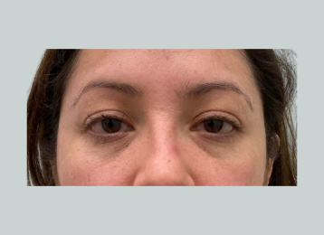 31658_undereye_filler_before