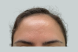 32089-intracel-forehead-female-before