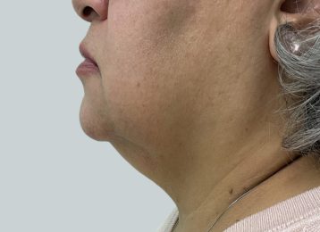 32171-coolsculpting-female-chin-after