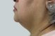 32171-coolsculpting-female-chin-after