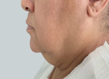 32171-coolsculpting-female-chin-before