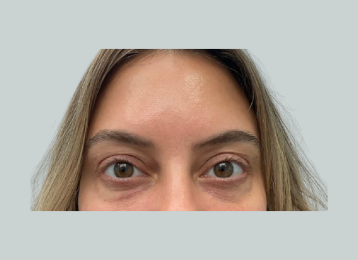 32874_undereye_filler_after