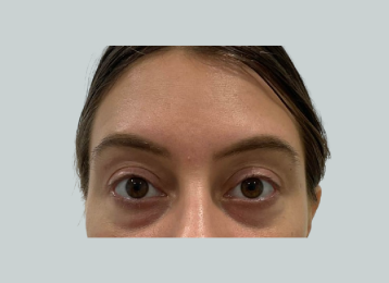 32874_undereye_filler_before