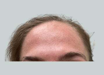 33053_female_dysport_forehead_after