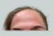 33053_female_dysport_forehead_after