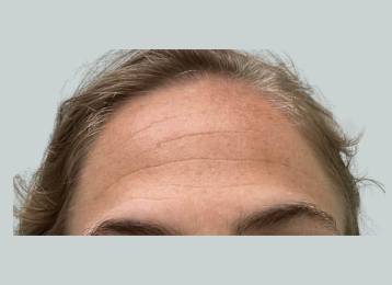 33053_female_dysport_forehead_before