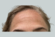 33053_female_dysport_forehead_before